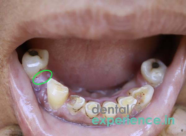 Multiple missing teeth